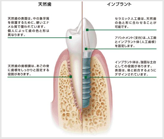 インプラントについて